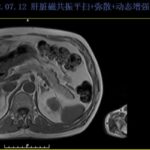 晚期直肠癌患者九年生存奇迹：多线靶向治疗与精准用药策略解析