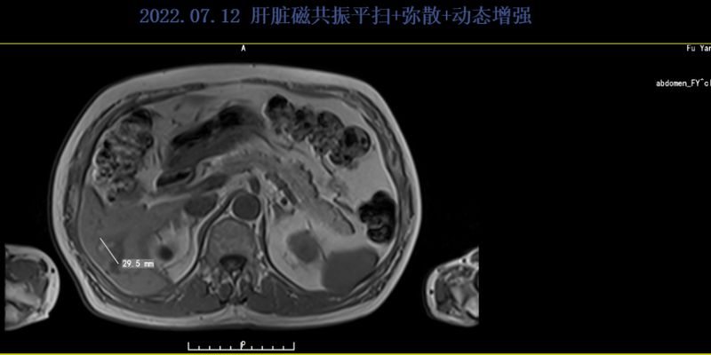 晚期直肠癌患者九年生存奇迹：多线靶向治疗与精准用药策略解析
