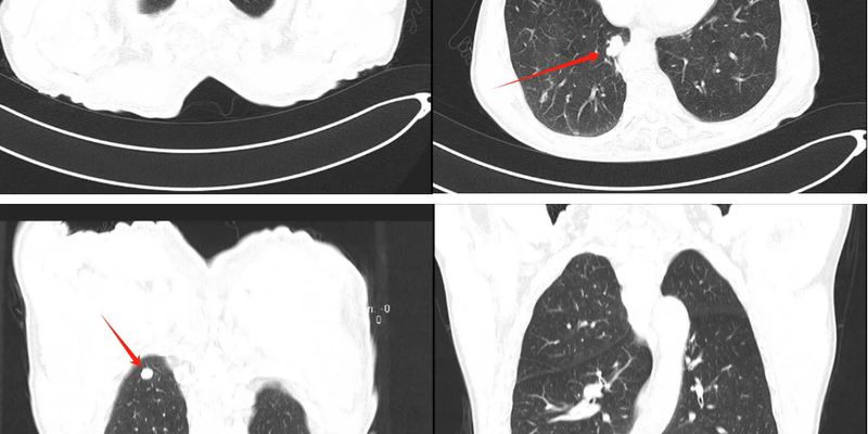 肺上皮样血管内皮瘤（PEHE）深度解析：罕见肺部肿瘤的诊断与靶向治疗前景