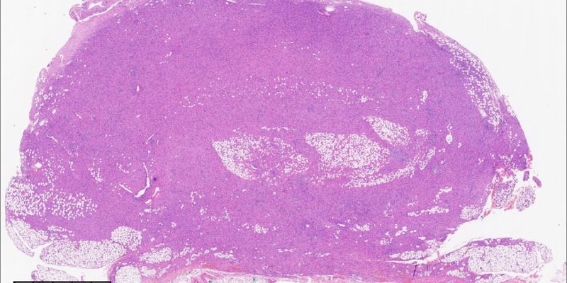 NTRK重排梭形细胞肿瘤:罕见病例解析与靶向治疗新希望