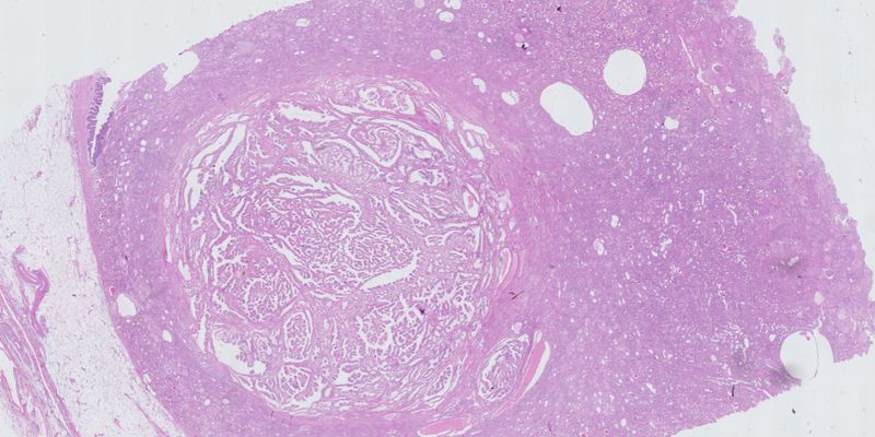 透明细胞乳头状肾细胞肿瘤：深入解析其病理特征与预后