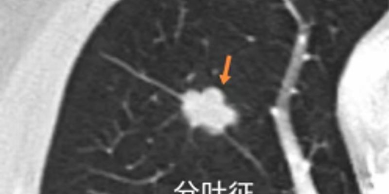 肺结节CT影像：识别恶性肺癌的九大关键特征