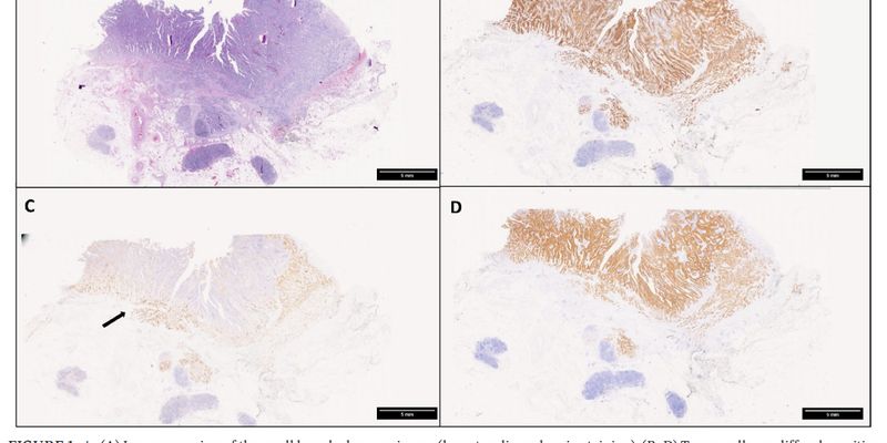 小肠腺癌与BRCA2基因突变：遗传检测如何影响靶向药治疗与抗癌药选择？