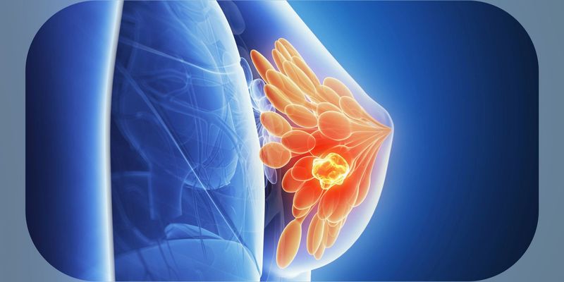乳腺癌靶向药治疗新突破：液体活检如何助力精准用药与疾病监测