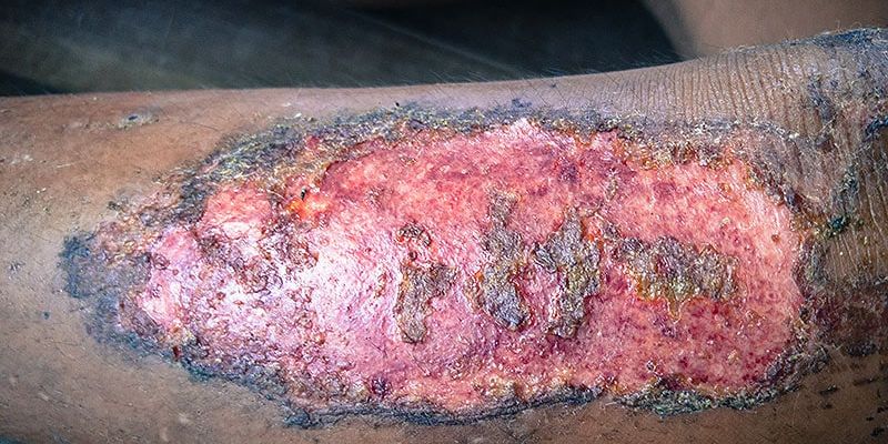 靶向药Rigosertib：RDEB相关鳞状细胞癌治疗的新希望