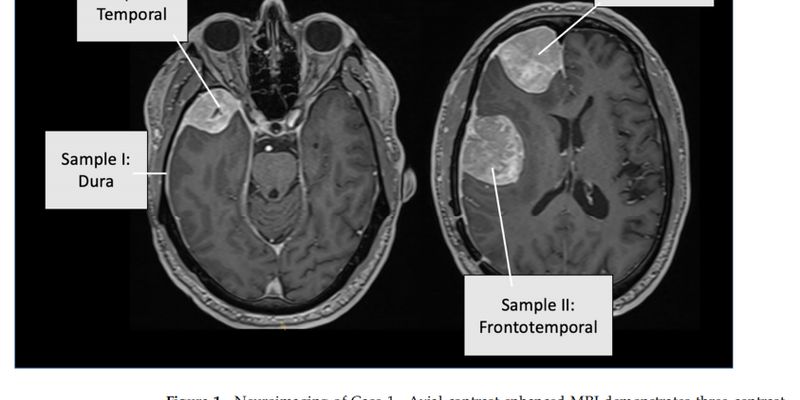 罕见胶质瘤诊断之路:4个病例揭示DNA甲基化与NGS检测如何重塑治疗与预后