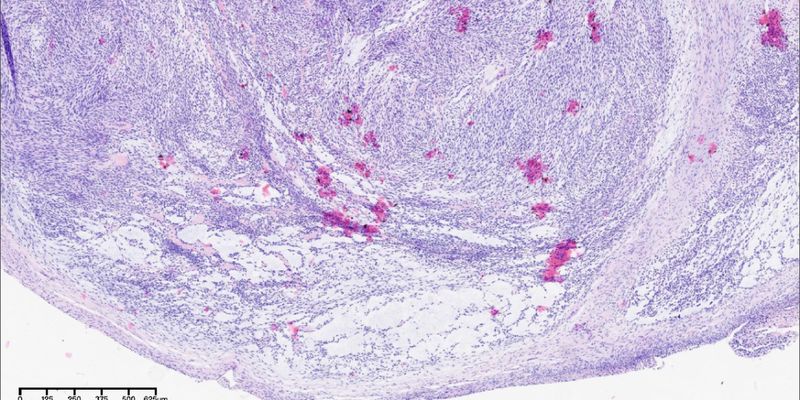 EWSR1-SMAD3纤维母细胞肿瘤：一种罕见软组织肿瘤的诊断与病理全解析