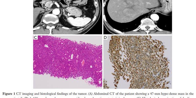 BRCA2突变胰腺腺泡细胞癌新希望：mFOLFIRINOX化疗助患者成功手术