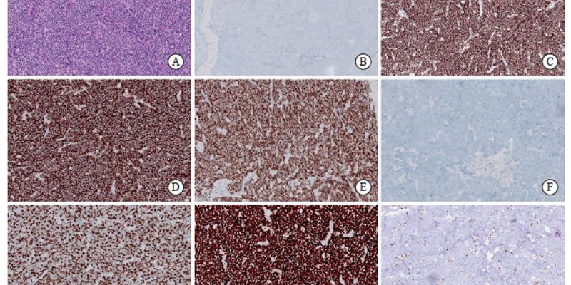 食管小细胞癌生存率有多高？最新研究对比手术与放化疗效果，揭示最佳治疗策略