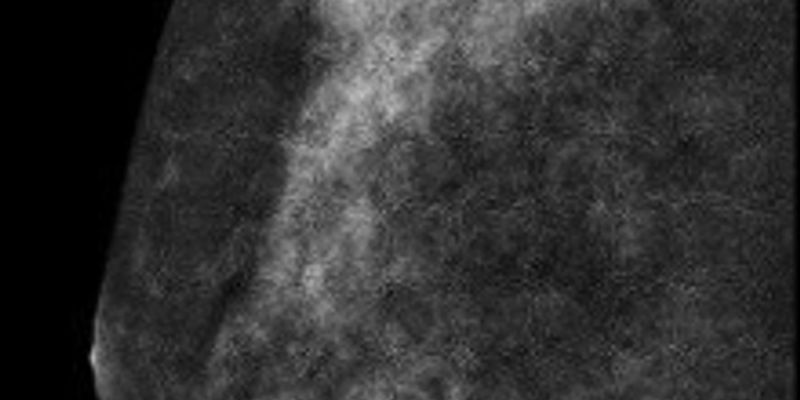 病理报告解读:乳腺具有髓样特征的浸润性癌是什么?治疗与预后全解析