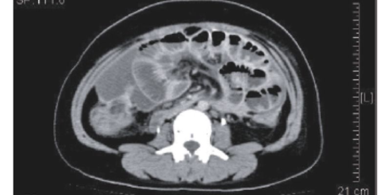 化疗腹泻管理指南:如何处理伊立替康、5-氟尿嘧啶等药物引起的严重腹泻?