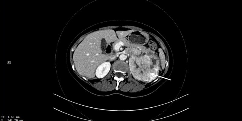 FH缺陷型肾细胞癌是什么?一文读懂这种罕见肾癌的诊断与治疗