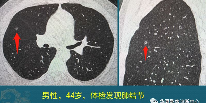 肺结节离肺癌有多远？从真实病例看肿瘤的生长速度与风险