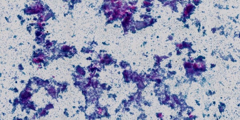 肝脾T细胞淋巴瘤诊断全解析：从症状、病理到治疗方案