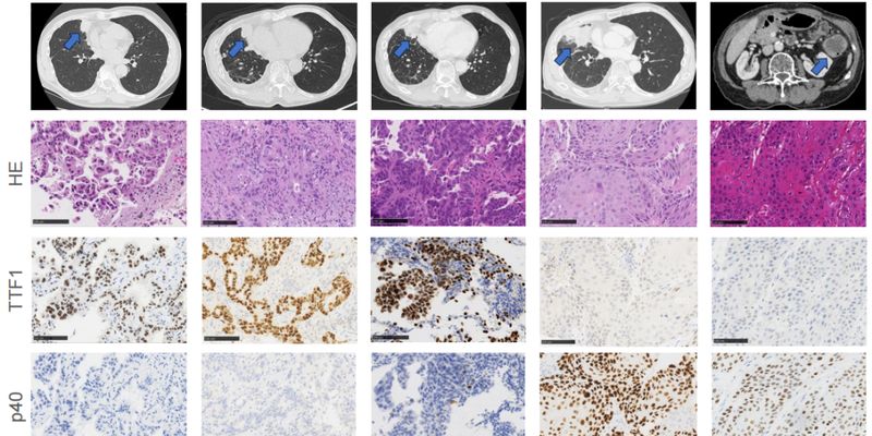 EGFR肺腺癌耐药后转化为鳞癌?新研究揭示FGFR1/NSD3扩增是关键