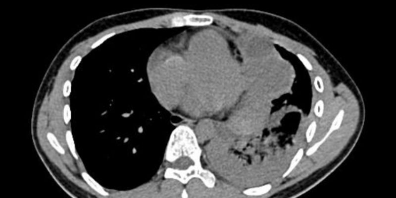 原发性纵隔卵黄囊瘤：从一例病例看懂这种罕见肿瘤的诊断与治疗