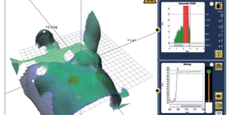 保护心脏，更精准！分次内CBCT技术优化左侧乳腺癌DIBH放疗