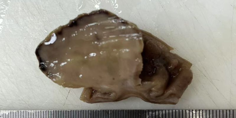 罕见小肠肿瘤：软组织血管纤维瘤的诊断与病理特征全解析