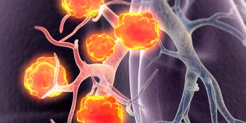斯鲁利单抗(Serplulimab)联合化疗显著改善老年广泛期小细胞肺癌患者生存期