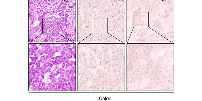 林奇综合征与结直肠癌:MLH1基因新型突变如何影响癌症易感性?