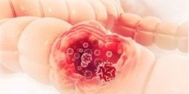 奥沙利铂辅助治疗结直肠癌：年龄与分期如何影响生存获益？