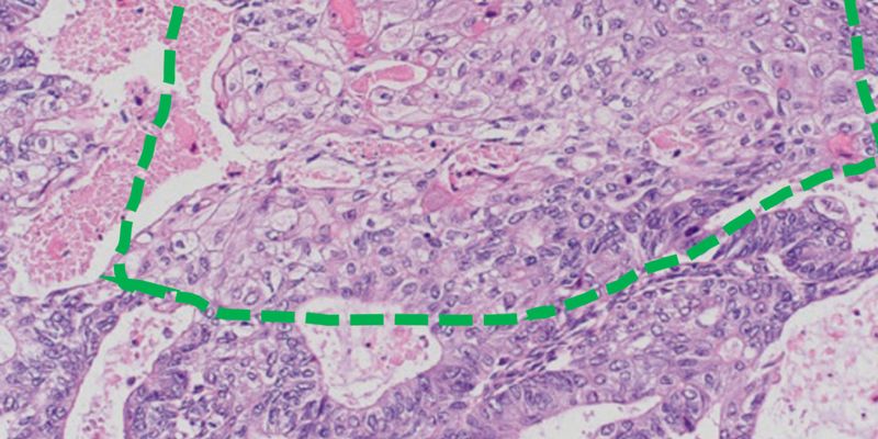解读您的病理报告：子宫内膜样癌的10种变异形态及其临床意义