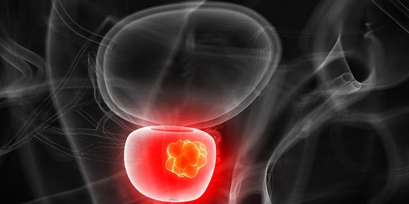 高危前列腺癌治疗新进展:放疗与手术,哪种方案更优?