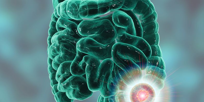 最新研究：奥沙利铂用于结直肠癌辅助化疗，年龄是关键获益因素