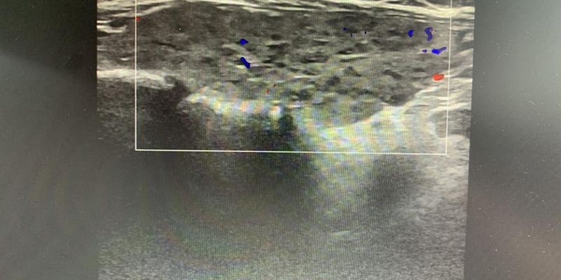 甲状腺鳞状细胞癌(间变性癌)深度解析:从病例看诊断与预后