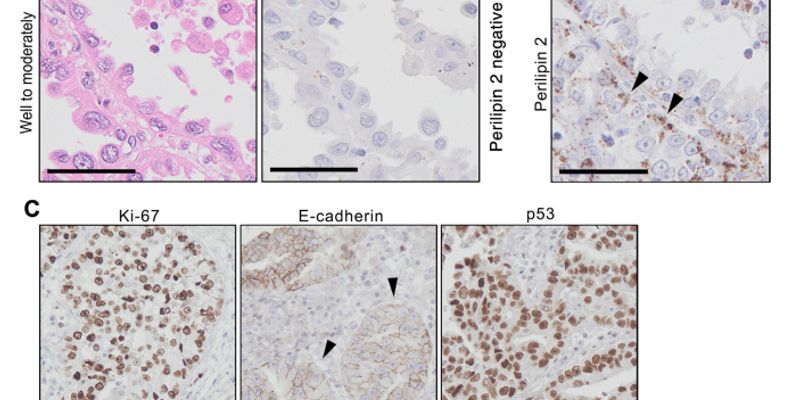 肺腺癌治疗新方向：Perilipin 2蛋白如何影响预后与肿瘤进展？