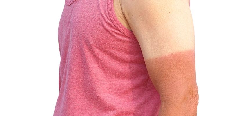 警惕致命的“日晒纹身”：当心艺术潮流背后的皮肤癌风险