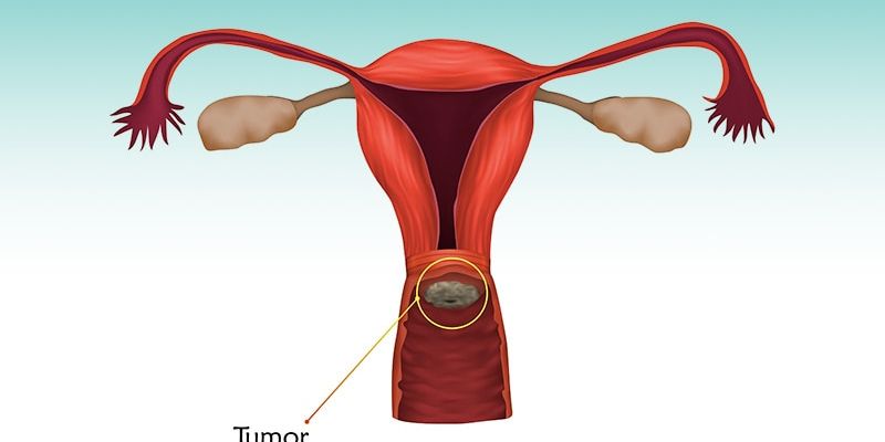 宫颈癌筛查率与死亡率直接相关：如何通过筛查有效预防？