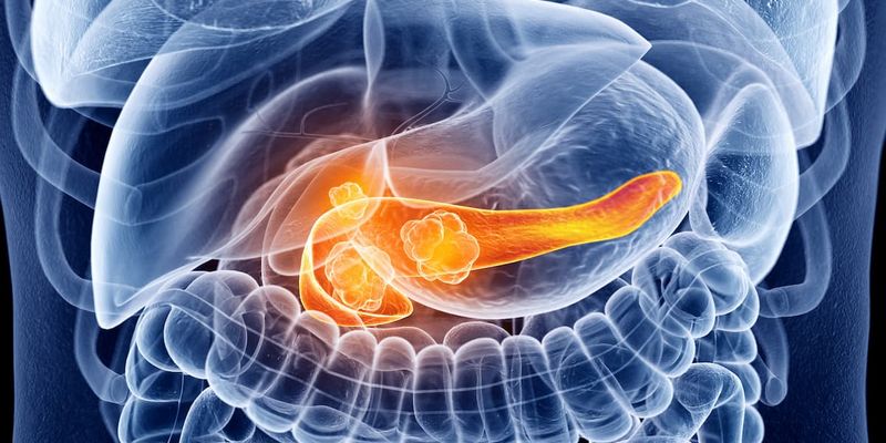胰腺癌治疗新希望：TTFields联合化疗方案显著延长患者生存期，FDA上市申请已提交