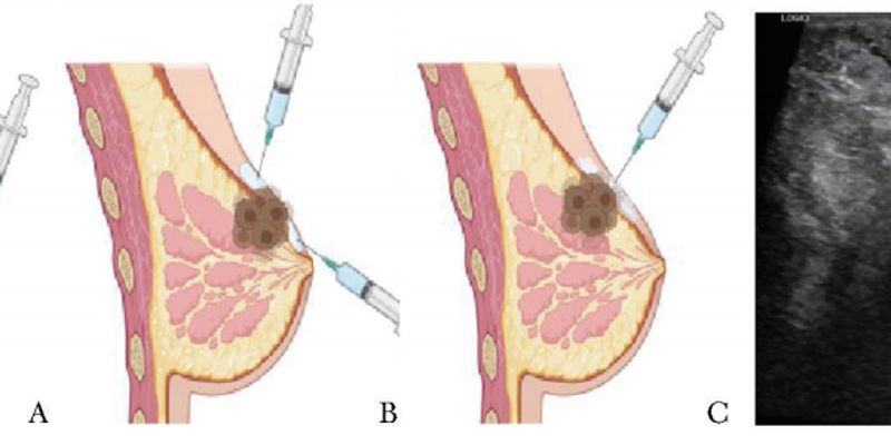 晚期乳腺癌治疗新突破：微波消融术对侵犯皮肤的肿瘤安全有效吗？