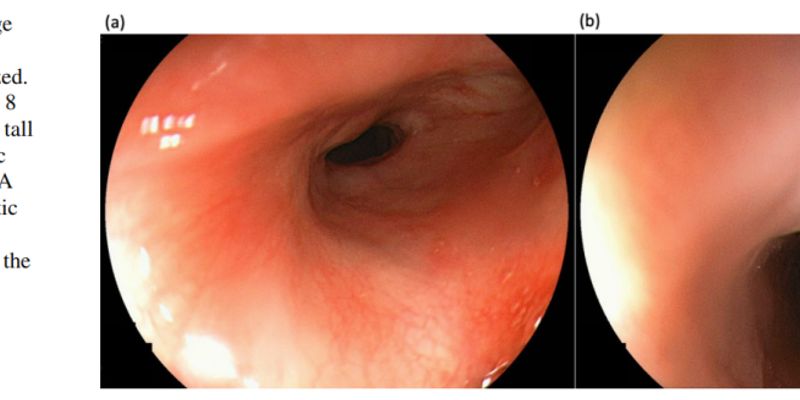 罕见食管鳞癌病例:基因检测揭示FGFR1与MYC扩增的关键作用