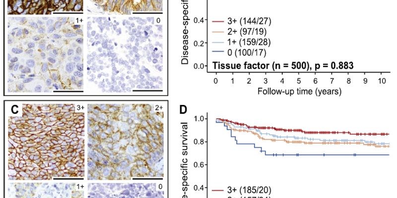 80%宫颈癌患者或受益!研究揭示TROP2等ADC新靶点在鳞癌和复发性肿瘤中的高表达