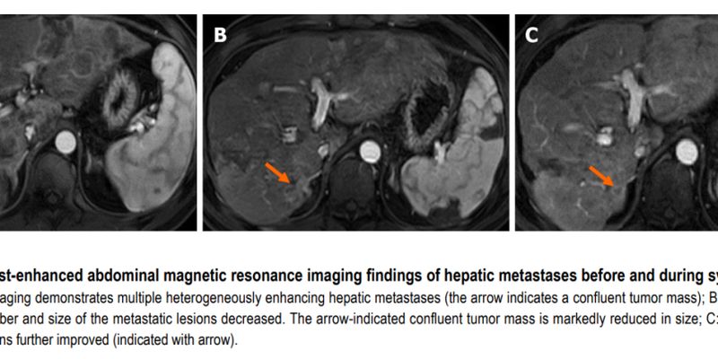 晚期胰腺癌肝转移患者的精准治疗:BRCA2突变与奥拉帕利联合方案的突破
