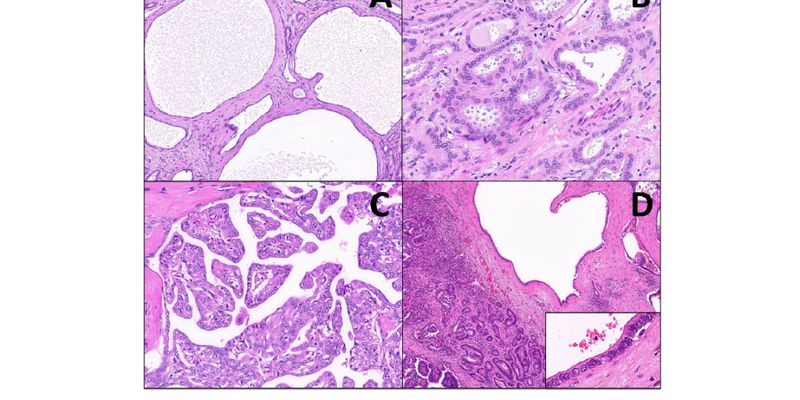 警惕胆管腺纤维瘤恶性风险:揭示与肝内胆管癌关联及IDH2、FGFR2等靶向基因变异
