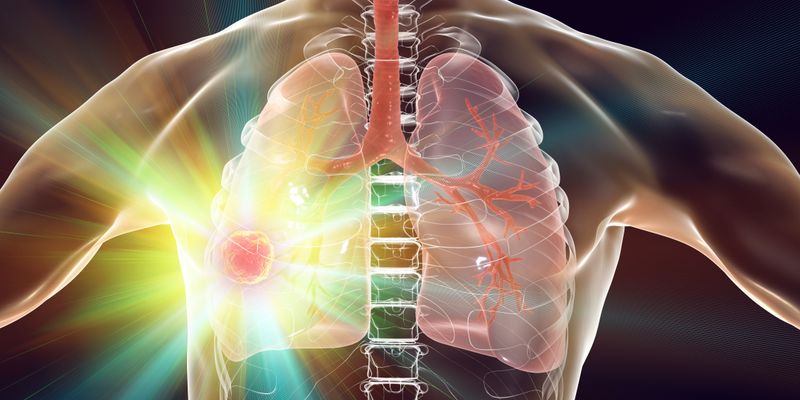 早期肺癌治疗新突破:VATS胸腔镜手术显著提升患者总体生存期