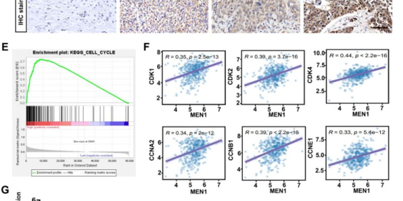膀胱癌治疗新突破：Menin如何驱动癌症进展，成为潜在靶点？