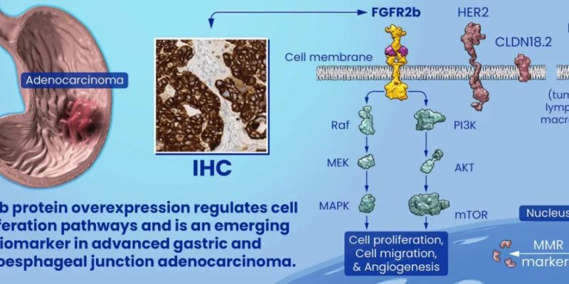 FGFR2b蛋白:胃癌与胃食管交界处腺癌靶向治疗的新希望