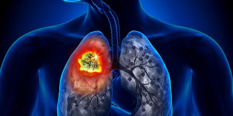 日本批准TTFields联合免疫疗法/化疗,晚期非小细胞肺癌(NSCLC)患者生存期显著延长