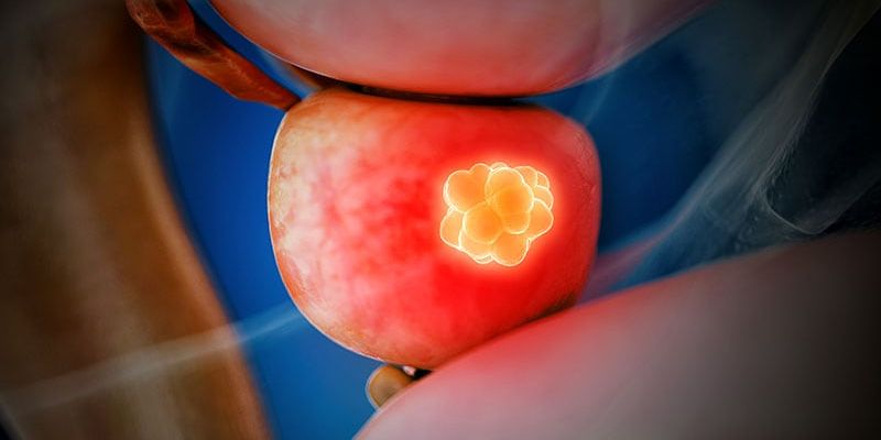 前列腺癌生化复发：PSMA-PET影像诊断的机遇与挑战