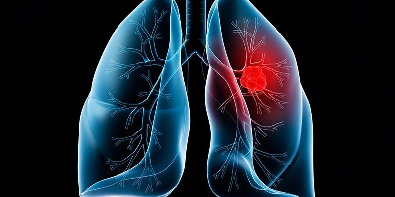非吸烟者肺癌发病率攀升：早期筛查与靶向免疫治疗成生存关键