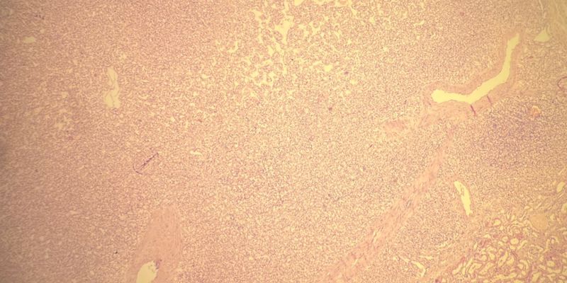 肾嗜酸细胞瘤:是良性还是恶性?全面解析诊断要点与病理特征