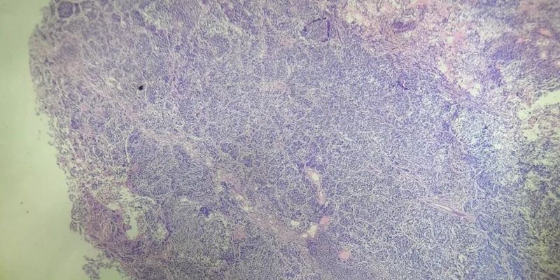 什么是肾骨外尤文肉瘤?全面解析其临床特征、病理诊断与EWSR1基因