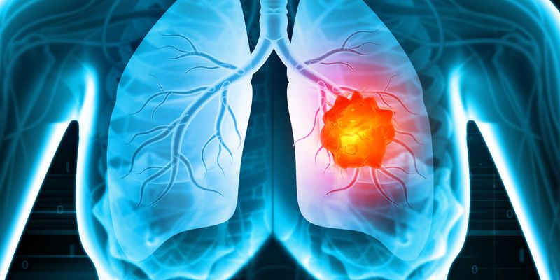 Zidesamtinib:ROS1阳性非小细胞肺癌治疗新突破,疗效显著且可及脑部病灶