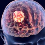 Iopofosine I 131获FDA罕见儿科病认证，为儿童胶质瘤治疗带来新曙光