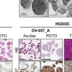 告别试错！“微型肿瘤”技术精准预测晚期卵巢癌化疗与PARP抑制剂疗效