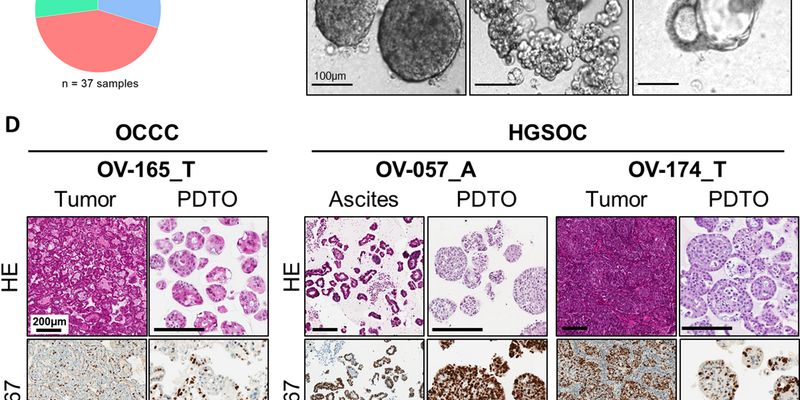 告别试错!“微型肿瘤”技术精准预测晚期卵巢癌化疗与PARP抑制剂疗效